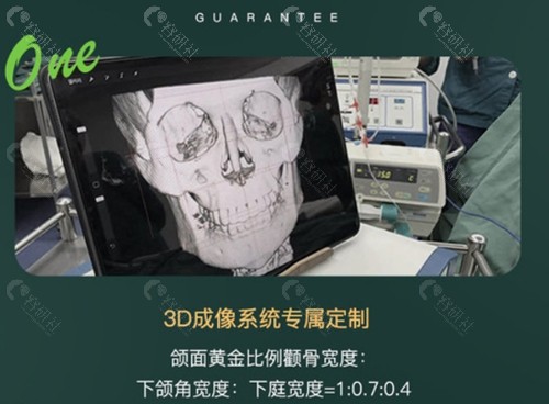 杭州时光陈小平下颌角整形配合3D成像系统