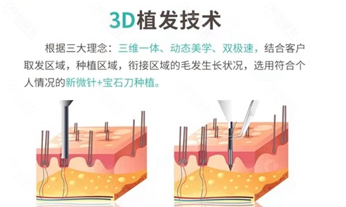 南京新生3D植发技术怎么样？