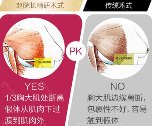 南宁华美赵广生隆胸优势和传统隆胸区别