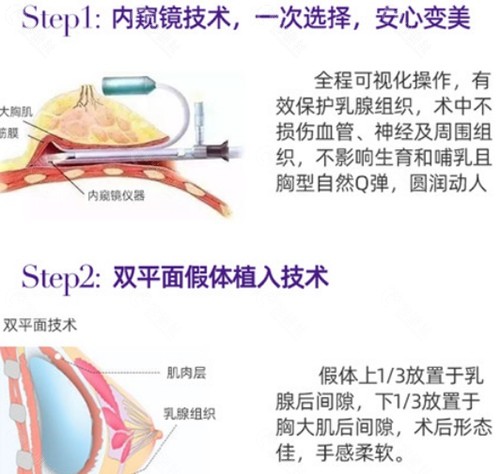 南宁美丽焦点假体隆胸优势介绍