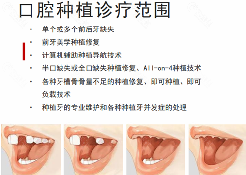 北京牙管家口腔种植科诊疗范围