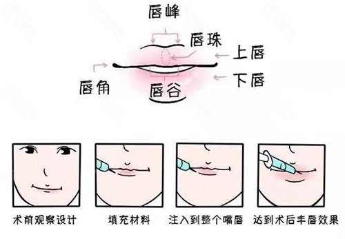 玻尿酸丰唇手术过程
