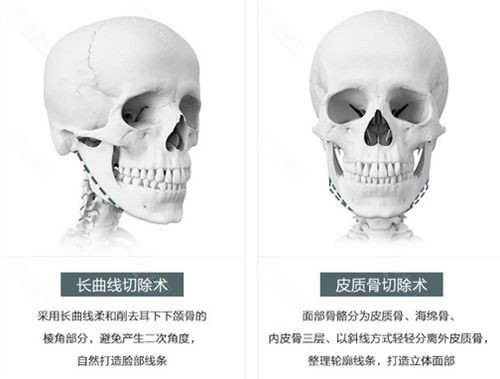 北京右安门医疗美容科长曲线下颌角手术原理