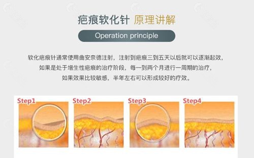 北京右安门医疗美容科疤痕软化针优势