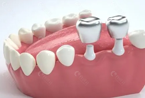 种植牙过程之牙冠安装