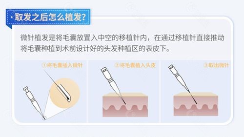 上海大麦微针植发技术优势