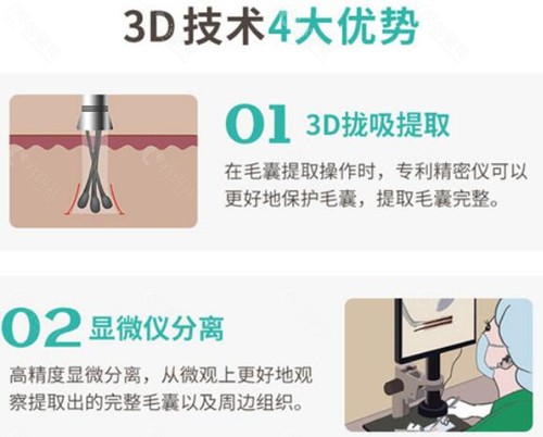 郑州新生植发3D植发技术优势介绍