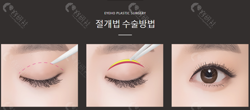 韩国爱护整形医院双眼皮手术原理