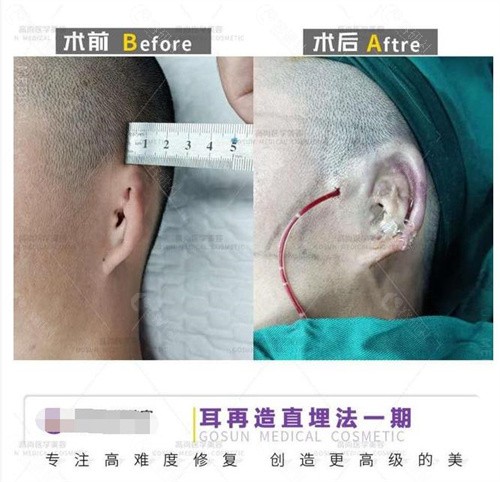 广州高尚医疗余文林小耳畸形做耳再造怎么样