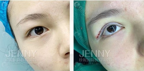 武汉珍妮医疗美容割双眼皮前后对比照