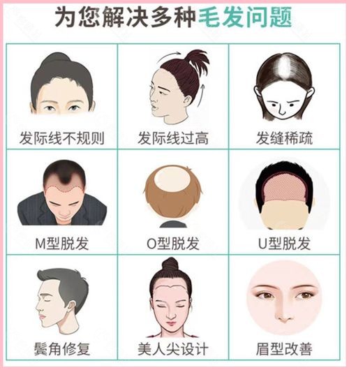 广州植发公认技术好的新生植发主要解决的问题
