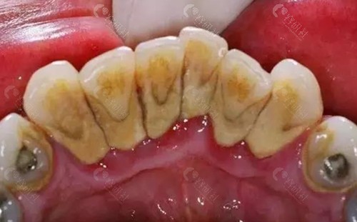长期不洗牙牙结石的危害大吗内附牙结石图片慎入