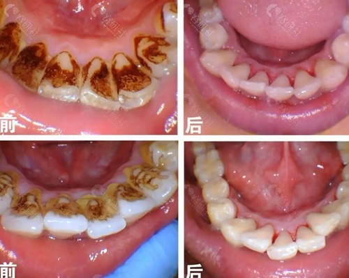 长期不洗牙牙结石的危害大吗内附牙结石图片慎入