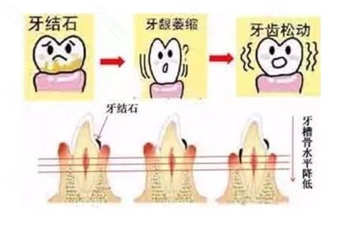 牙结石导致牙齿松动