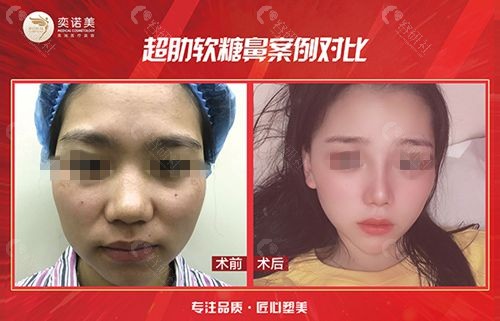 新乡奕诺美张红亮超肋软糖鼻图片