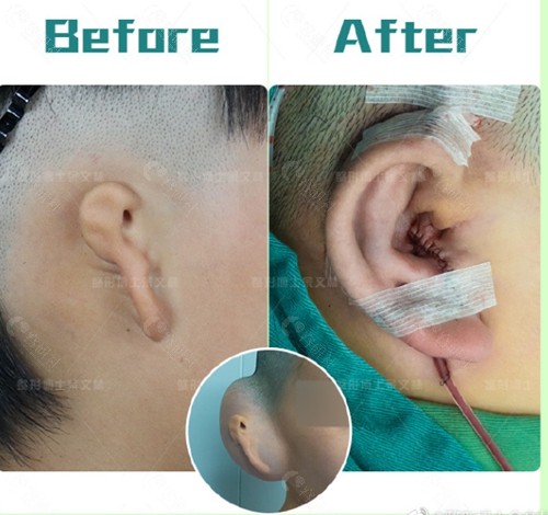 广州耳朵畸形手术医院