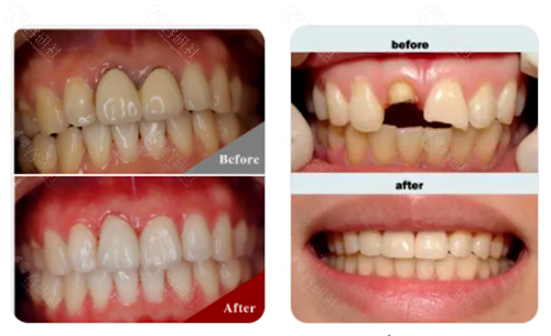 烤瓷牙修复牙齿对比图