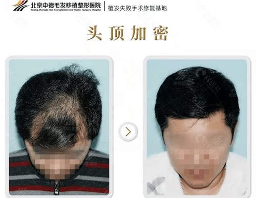 北京中德毛发移植对比照