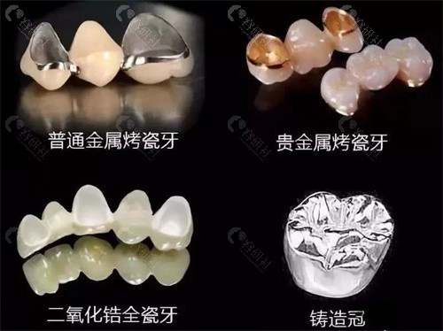 牙齿修复中牙冠种类