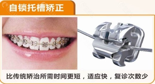 金属自锁托槽牙齿矫正优缺点