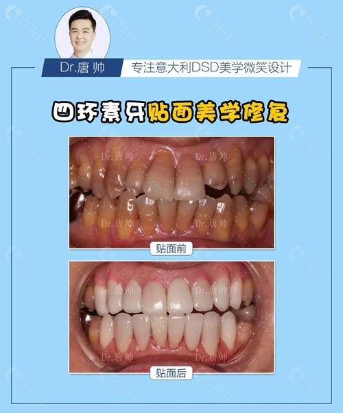 北京雅医家口腔正畸医生唐帅四环素牙贴面美学修复图片