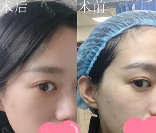 北京煤医做光子嫩肤前后对比照