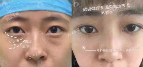 武汉艺星医疗美容祛眼袋对比照