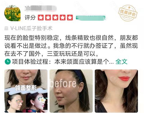 上海时光下颌角手术术后评价