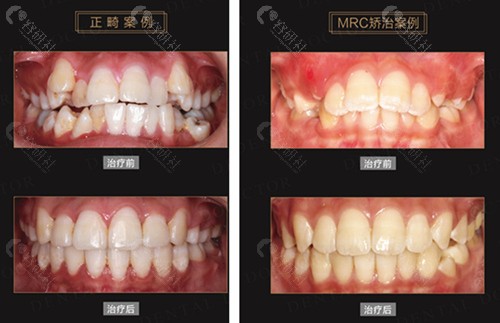 昆山口腔医院牙齿矫正前后对比照