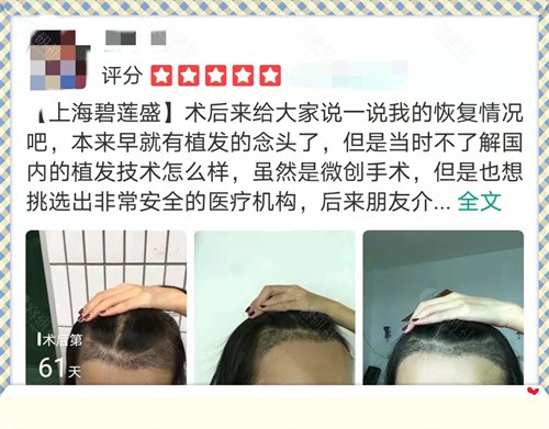 上海碧莲盛植发受骗是真是假价格表及评价看植发不坑人