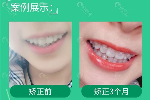 上海尤旦口腔医院牙齿矫正前后对比照