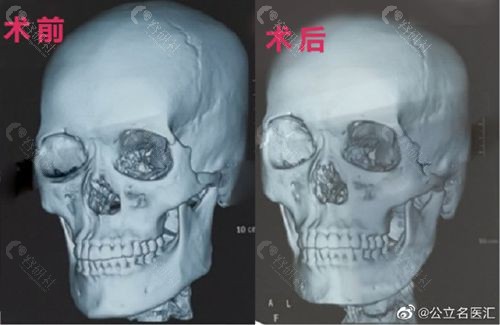 北京八大处靳小雷下颌角长曲线截骨+下巴环切术前后对比图
