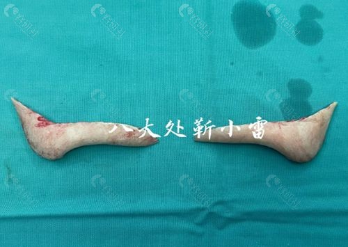北京磨骨有名的医生八大处靳小雷长曲线下颌角磨骨后取骨图片