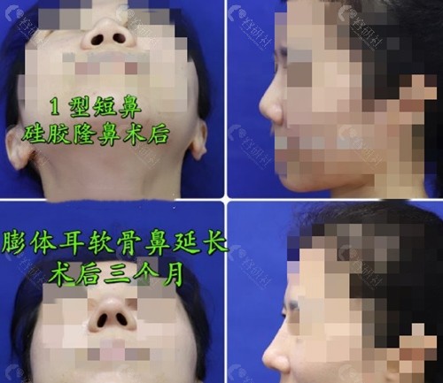 上海九院戴传昌隆鼻术前术后对比