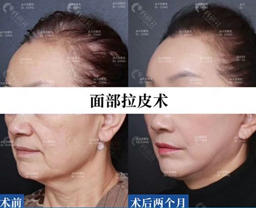 上海拉皮除皱技术好的伯思立丛大忞面部拉皮术前后对比图