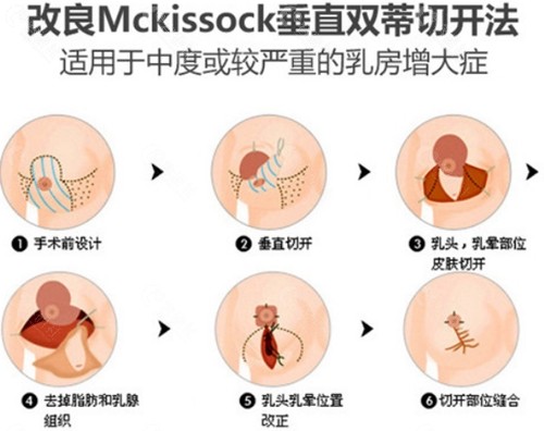 上海时光缩胸手术方式介绍