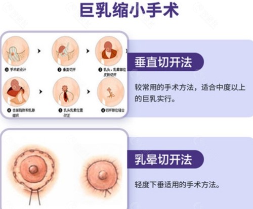 上海市东方医院缩胸手术方法介绍