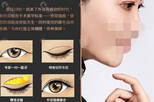 北京永成医疗美容双眼皮手术方法