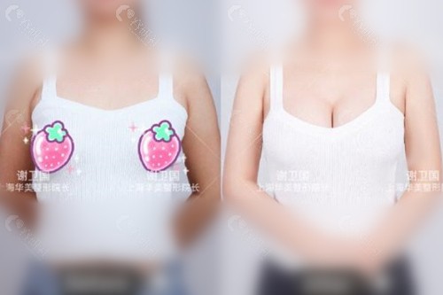 上海华美圆形假体隆胸前后对比照