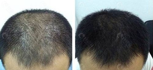 米诺地尔生发液治疗脱发一般多久见效？停用后会复脱吗？