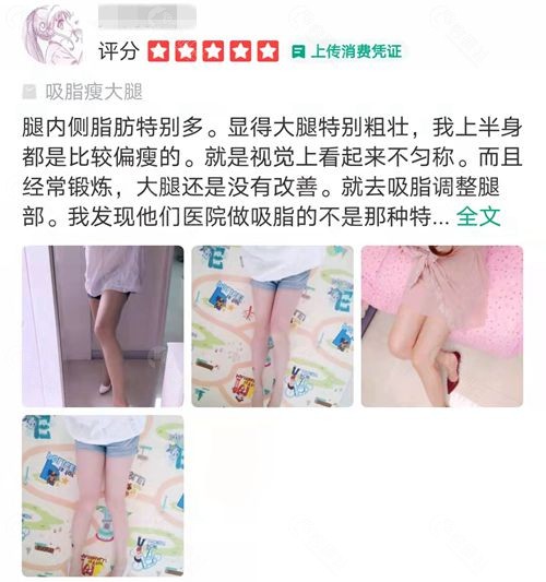 桂林华美整形医院吸脂术后评价