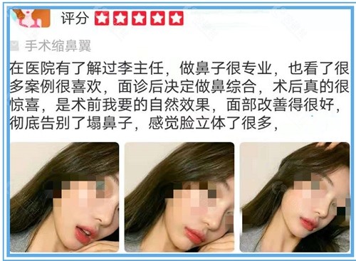 广州海峡美容医院鼻翼缩小术后反馈