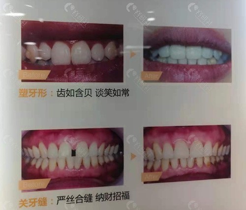 成都新桥口腔牙齿修复术前术后对比