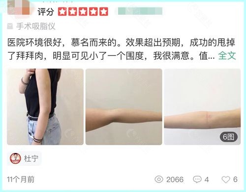 北京星灿宫吸脂塑形口碑好不好？来看网友吸脂瘦手臂后的真实感受