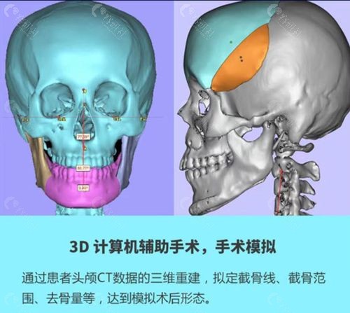 上海磨骨有名的医生何晋龙下颌骨3D缩小术