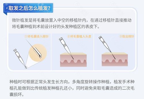 大麦微针植发技术