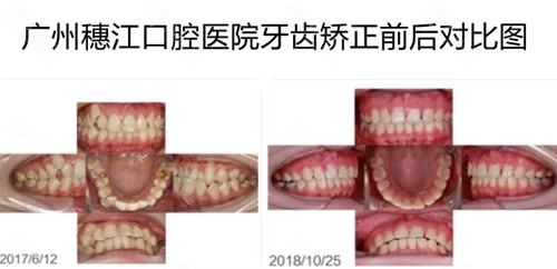 广州穗江口腔医院牙齿矫正前后对比照
