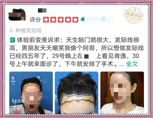 广州青逸植发医院种植发际线评价