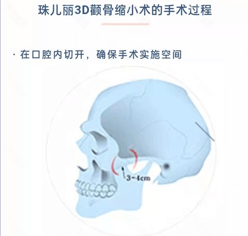 韩国珠儿丽医院颧骨内推怎么样