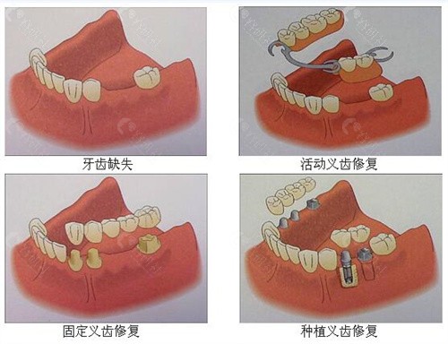 镶牙和种牙优缺点有哪些